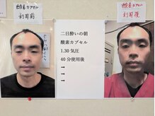 もみの樹/酸素カプセル効能例（2日酔い）