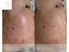 人気No.1【平日予約限定価格♪】剥けるハーブピーリング＋鎮静パック