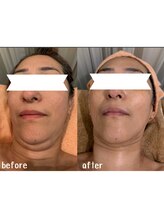 ラディアント(Radiant)/インディバ/レモンボトル