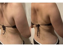 ユー 喜連西店(U)/脂肪冷却【before　after】
