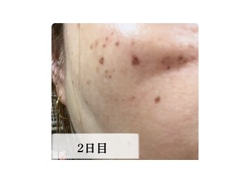 ラビエス(LAVIES)/シミケア施術２日目