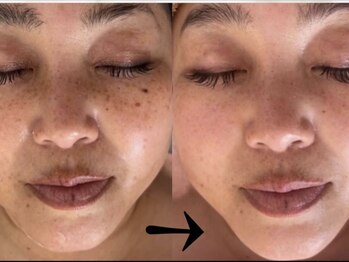 サロン ドロップ 上小田井(Salon drop)/「シミ改善」途中経過