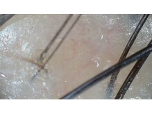 はる鍼灸整骨院/驚愕のダーマ鍼！美髪