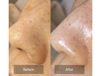 アウラ(Aula)/小鼻もツルツル