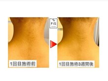 フィズ 練馬店(&FIS)/☆気になるうなじの脱毛も☆