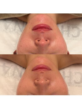 リレアボーテ(RILEA BEAUTE)の写真/【何をしてもダメだった方へ】”最新LDM”×”クリスティーナ”で叶える、羨望の根本肌質改善!発光美肌へ♪