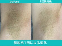 ミスターアンクール 鹿児島(Mr.uncoeur)/脇脱毛1回