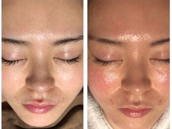 サロン ラズリ(SALON Lazuli)/【毛穴洗浄】シミ/美白