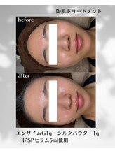 ヒーリングハーツ(Healing Hearts)/ハーブピーリング/清水町/肌ケア