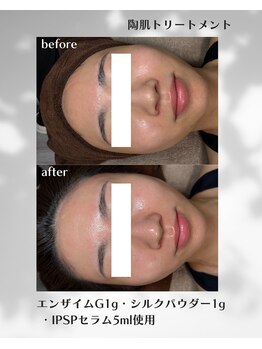 ヒーリングハーツ(Healing Hearts)/ハーブピーリング/清水町/肌ケア