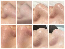 トータルビューティ ノイド(Noid)の雰囲気（毛穴洗浄&ピーリング♪小鼻コース￥1980～）