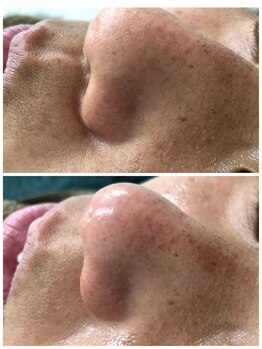 ヒルナム(Heal Nam)/毛穴エクストラクション