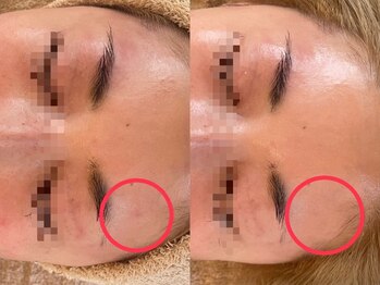 リノアンド(Lino&)/赤ら顔、痒みなどをやわらげる