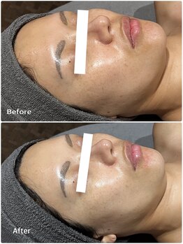 トータルビューティーサロン ヴィヴィエ(ViVier)/ララピール　1回目