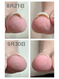 巻き爪ケア