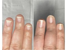 ルーモ(lumo.)の雰囲気（剥離爪もみるみる変化）