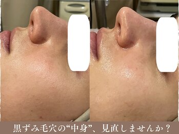 ポレ サロ(pore salo)/【乳酸ピール｜毛穴｜ざらつき】