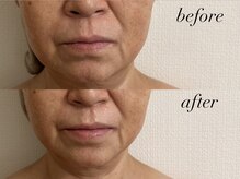 フウ(fuu.)/小顔カッサ