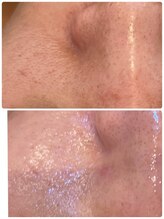 シュガー(Sugar...iyr)/プラズマニア　最高級EXO導入