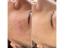 モア(moa)/ハーブピーリング