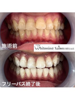 ホワイトニングサロン 京都烏丸店/ホワイトニング施術例