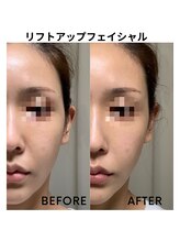 グリン(grin)/ハイブリッドフェイシャル（1）