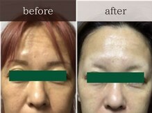 ティアラ/ハーブピーリング