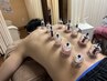 【Wの効果で全身スッキリ☆】炭酸鍼60分＋カッピング（吸い玉）20分