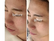 サロンド シェリー(Salon de Cherie)/ハーブピーリング