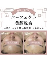 人気No.1【美顔脱毛】の流れ&プロのエステティシャンによるこだわりフェイシャルの内容