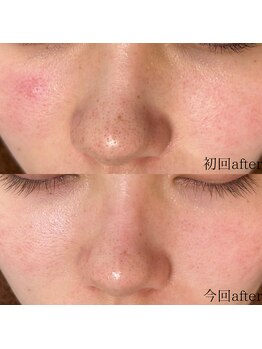 サロン ド エン(Salon de. en)/毛穴ケア◇ハーブピーリング