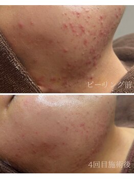 ミハン ボーテ(mihan.beaute)/【繰り返す大人ニキビ】