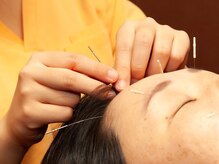 さらのて鍼灸院/充実のオプションメニュー