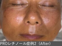 オアシスラグーン(OASIS LAGOON)/レチノール（症例2 after）