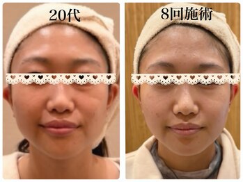 エピファニー(Epi phany Total Beauty Salon)/【小顔エステ】
