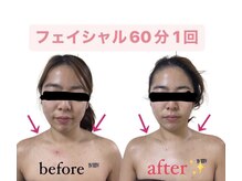 メゾンドケー(Maison de K)/フェイシャル60 Before→After