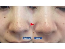 ハーシークレット(Her secret)/ハイドラ毛穴洗浄