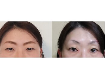 ミヤビ(miyabi)/人気の小顔矯正