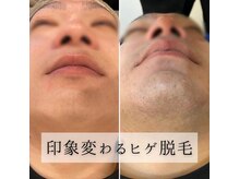 ニコリー(NICOLY)/メンズ髭脱毛【24回】