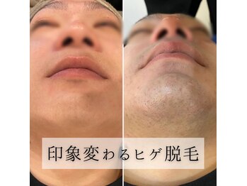 ニコリー(NICOLY)/メンズ髭脱毛【24回】