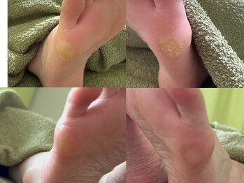 ベーネ(bene)の写真/【足のトラブル改善★】足の不調は、意外と角質にあり？？しっかりとチェックからさせて頂きます！
