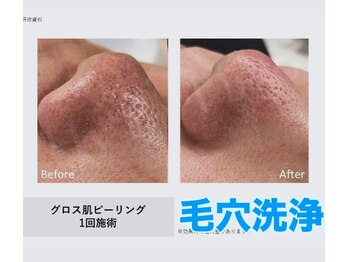 ティンク 心斎橋(Tink)/ハイドラピーリング