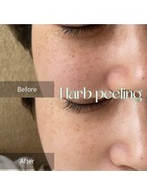 ティセ(TisseR)/ソフト / 2回目