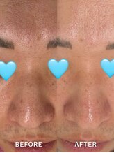 ベルミーランド マルエツ安行慈林/毛穴ケアBefore→After