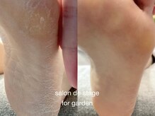 サロン ド ステージ フォー ガーデン(Salon de stage for garden)/角質ケア
