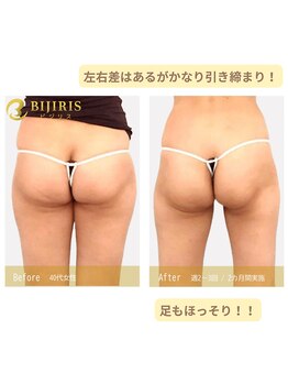 キングスサロン 熊本/お尻の変化が！