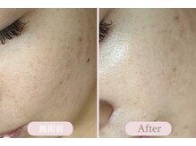 エピル(EPIL)/DEEPクリアスキン毛穴洗浄症例