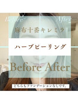 キレミラ 麻布十番店/ハーブピーリングbefore/after