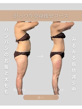 OBS新潟整骨院/脂肪冷却で脂肪減少♪人気NO,1