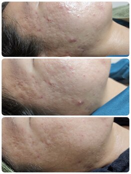 ル クラージュ(Le courage)/光フォト 2回目(20代)